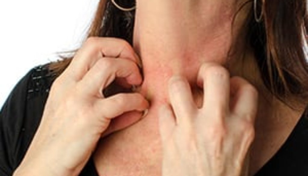 Chronic Hives Treatment