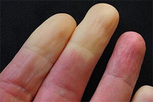 Raynaud's Disease